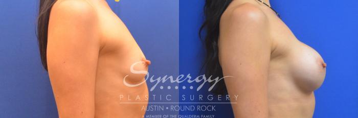 Before & After Breast Augmentation Case 793 Left Side View in Austin, TX