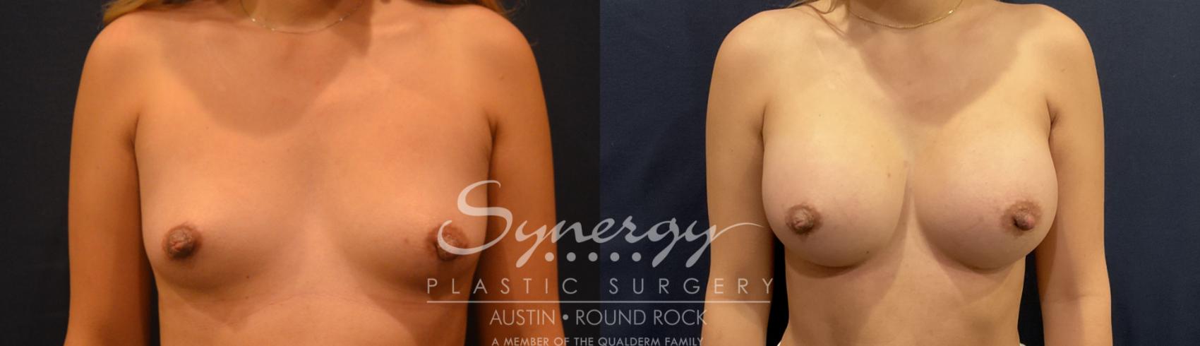 Before & After Breast Augmentation Case 796 Front View in Austin, TX