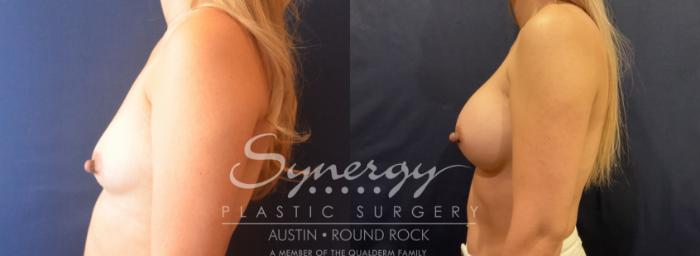 Before & After Breast Augmentation Case 796 right side  View in Austin, TX