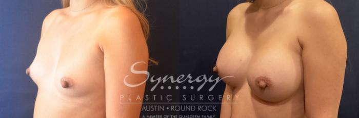 Before & After Breast Augmentation Case 796 Right Side View in Austin, TX