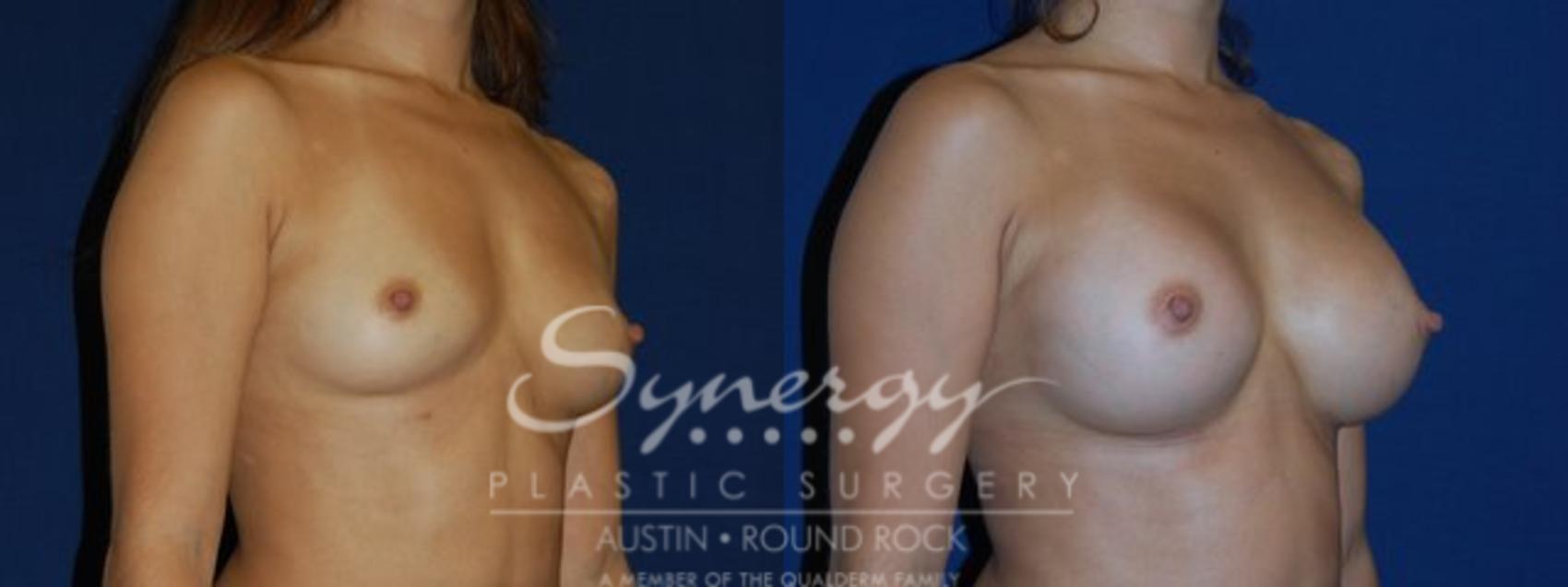 Before & After Breast Augmentation Case 80 View #1 View in Austin, TX