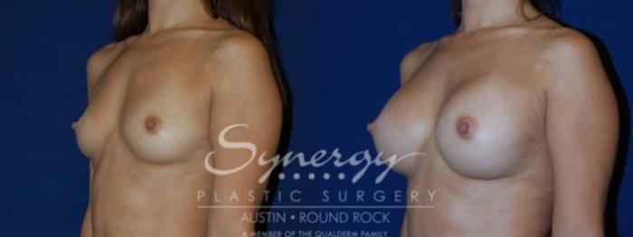 Before & After Breast Augmentation Case 80 View #3 View in Austin, TX