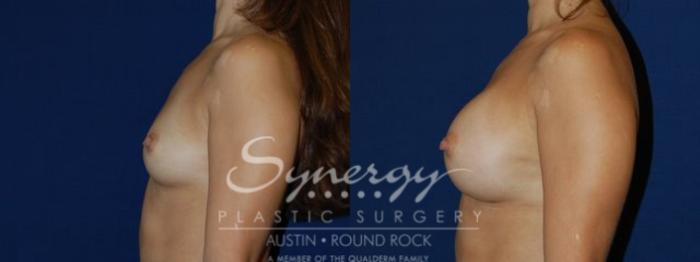 Before & After Breast Augmentation Case 80 View #4 View in Austin, TX