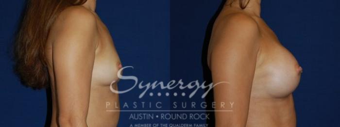 Before & After Breast Augmentation Case 80 View #5 View in Austin, TX