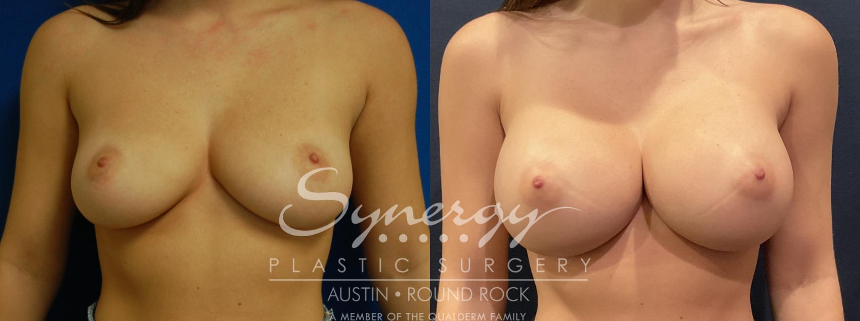 Before & After Breast Augmentation Case 801 Front View in Austin, TX