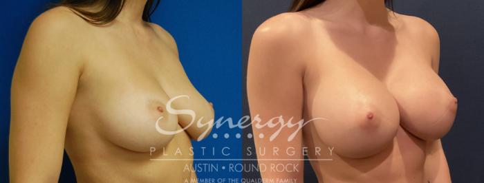 Before & After Breast Augmentation Case 801 Right Oblique View in Austin, TX
