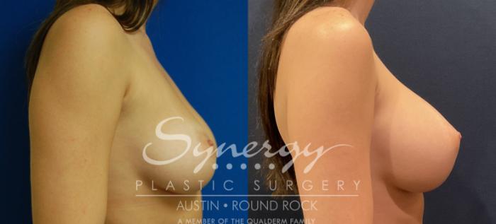 Before & After Breast Augmentation Case 801 Right Side View in Austin, TX