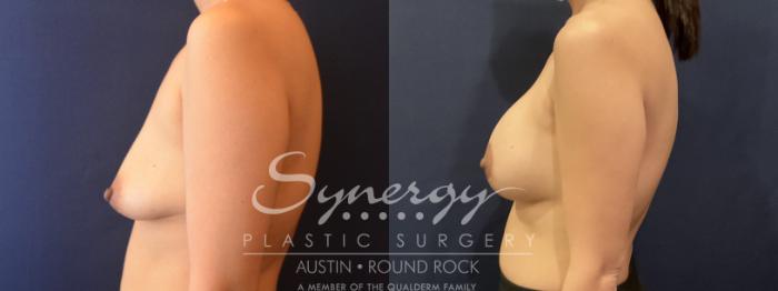 Breast Augmentation, Synergy Plastic Surgery, Silicone 