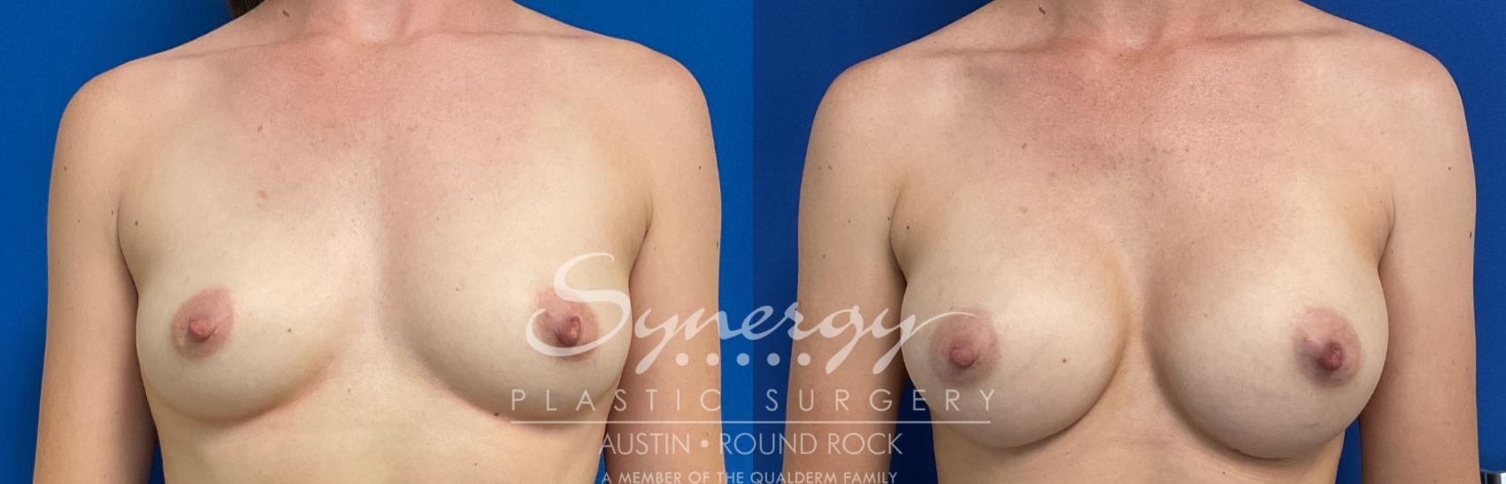 Breast Augmentation, Synergy Plastic Surgery
