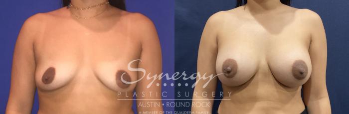 Before & After Breast Augmentation Case 808 Front View in Austin, TX