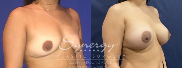 Before & After Breast Augmentation Case 808 Left Oblique View in Austin, TX