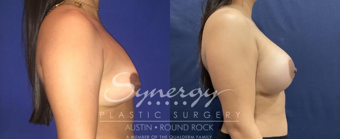 Before & After Breast Augmentation Case 808 Left Side View in Austin, TX