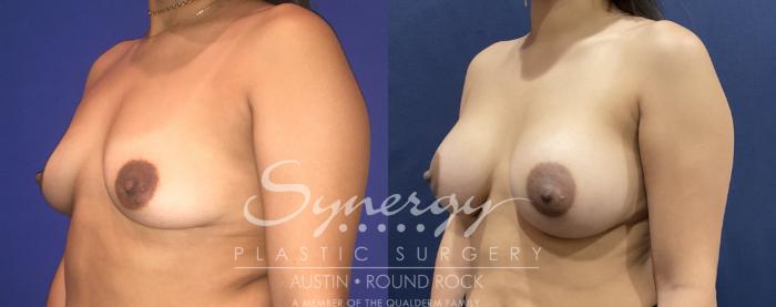 Before & After Breast Augmentation Case 808 Right Oblique View in Austin, TX