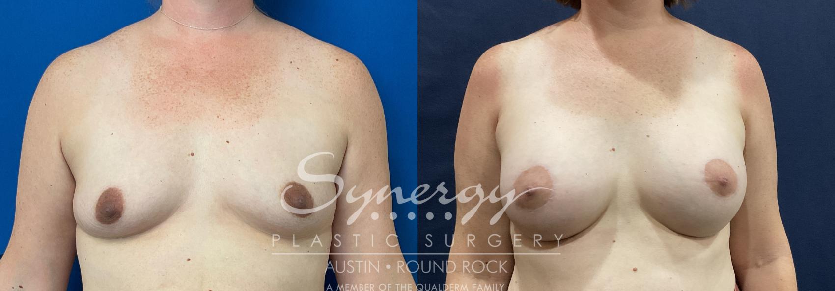 Before & After Breast Augmentation Case 810 Front View in Austin, TX