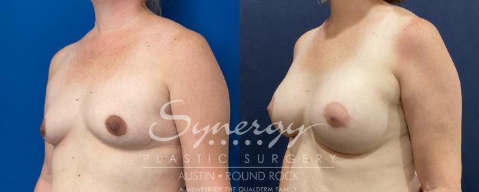 Before & After Breast Augmentation Case 810 Right Oblique View in Austin, TX