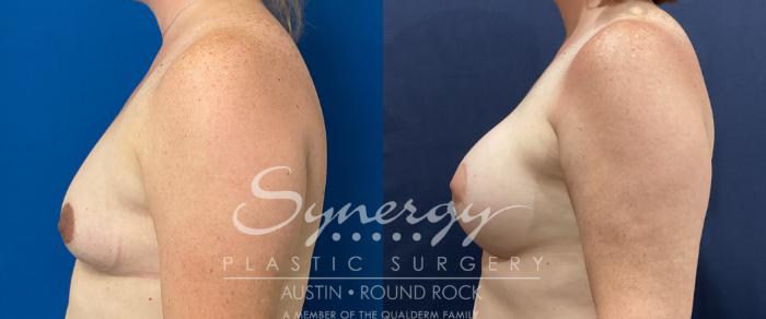 Before & After Breast Augmentation Case 810 Right Side View in Austin, TX