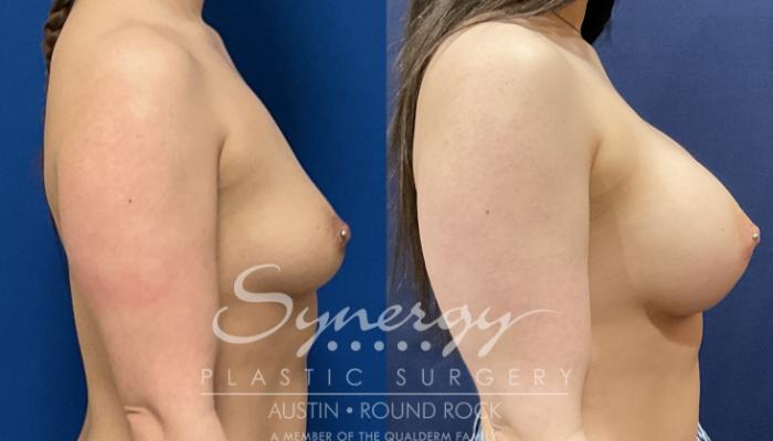 Breast Augmentation, Synergy Plastic Surgery, Silicone 