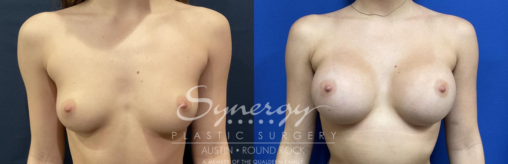 Before & After Breast Augmentation Case 818 Front View in Austin, TX