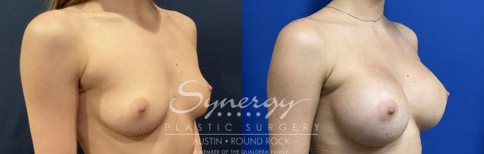 Before & After Breast Augmentation Case 818 Left Oblique View in Austin, TX