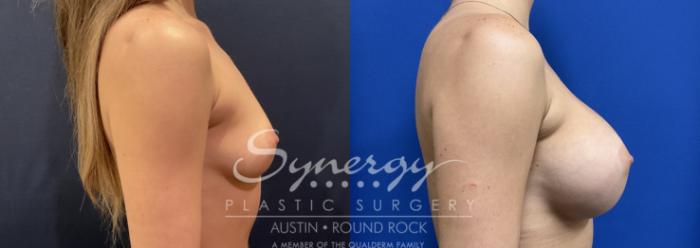 Before & After Breast Augmentation Case 818 Left Side View in Austin, TX