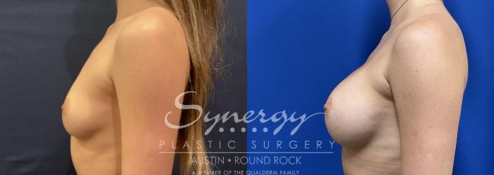 Before & After Breast Augmentation Case 818 Right Side View in Austin, TX