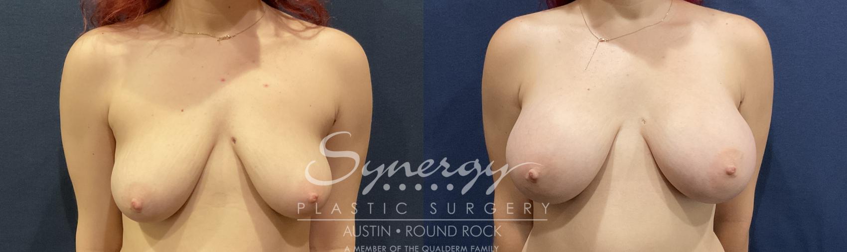 Before & After Breast Augmentation Case 819 Front View in Austin, TX