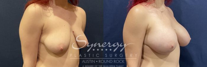 Before & After Breast Augmentation Case 819 Left Oblique View in Austin, TX