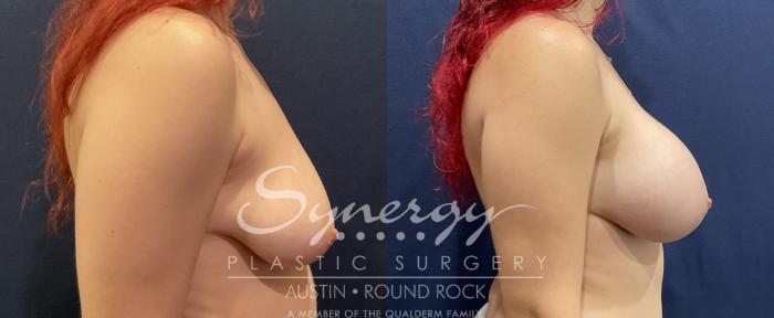 Before & After Breast Augmentation Case 819 Left Side View in Austin, TX