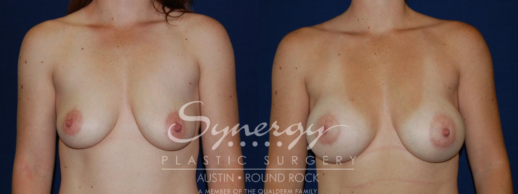 Before & After Breast Augmentation Case 82 View #1 View in Round Rock, TX