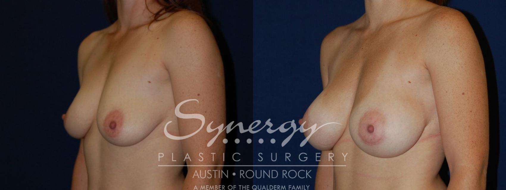 Before & After Breast Augmentation Case 82 View #2 View in Austin, TX