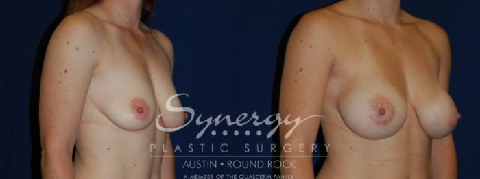 Before & After Breast Augmentation Case 82 View #3 View in Austin, TX