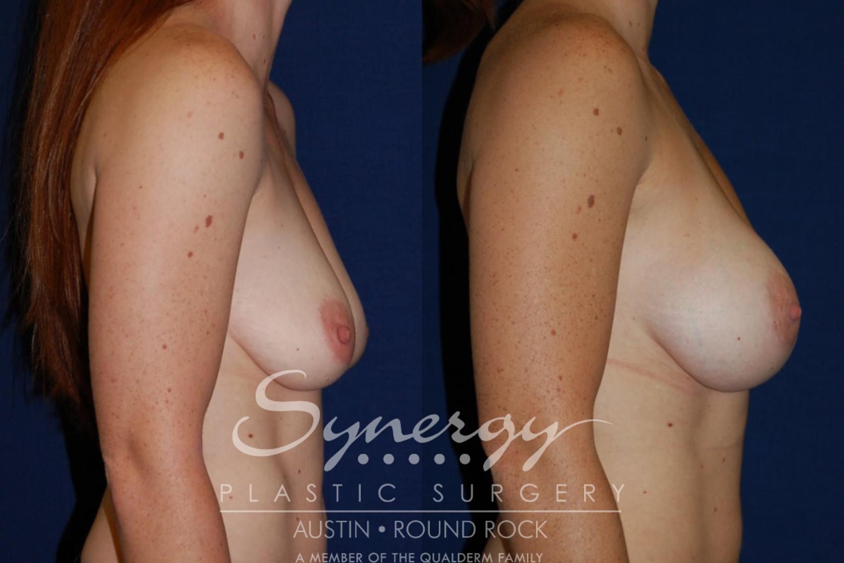 Before & After Breast Augmentation Case 82 View #4 View in Round Rock, TX