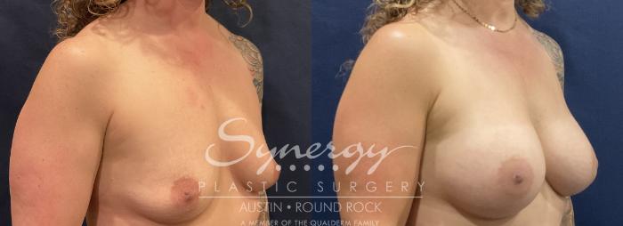 Before & After Breast Augmentation Case 821 Left Oblique View in Austin, TX