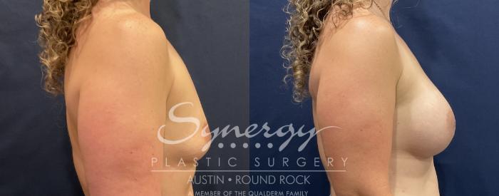 Before & After Breast Augmentation Case 821 Left Side View in Austin, TX