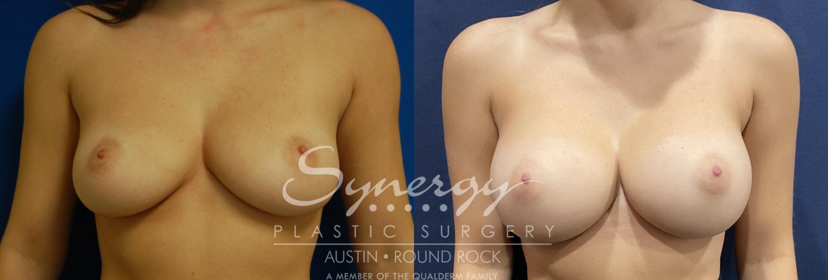 Before & After Breast Augmentation Case 822 Front View in Austin, TX