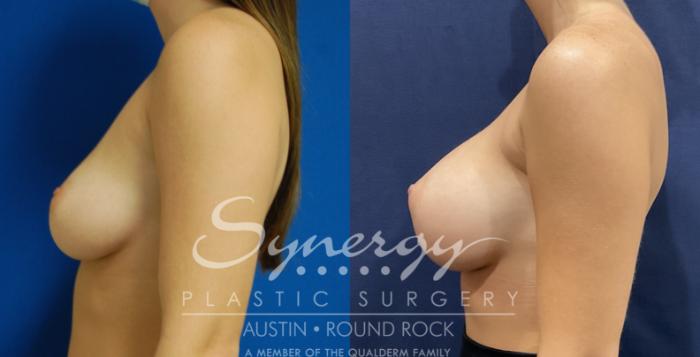 Before & After Breast Augmentation Case 822 Right Side View in Austin, TX