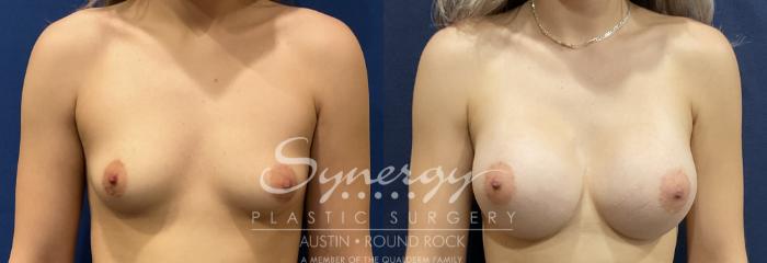 Before & After Breast Augmentation Case 823 Front View in Austin, TX