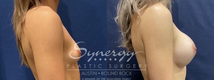 Before & After Breast Augmentation Case 823 Left Side View in Austin, TX
