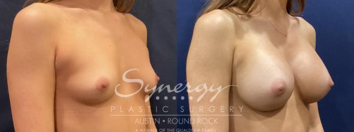 Before & After Breast Augmentation Case 824 Left Oblique View in Austin, TX