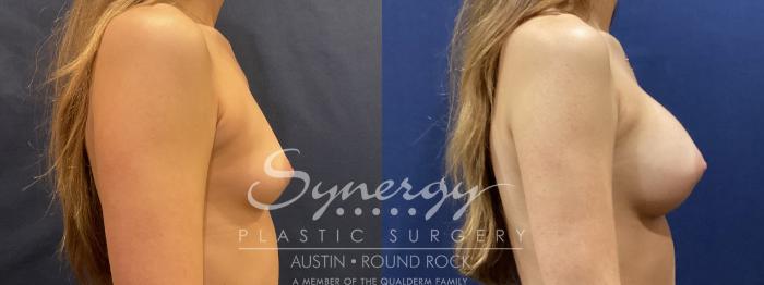 Before & After Breast Augmentation Case 824 Left Side View in Austin, TX