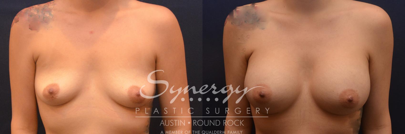 Before & After Breast Augmentation Case 833 Front View in Austin, TX