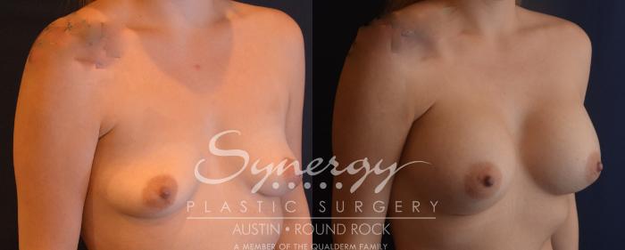 Before & After Breast Augmentation Case 833 Left Oblique View in Austin, TX