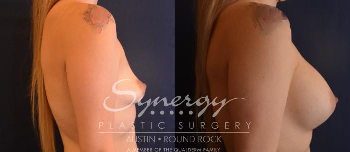 Before & After Breast Augmentation Case 833 Left Side View in Austin, TX