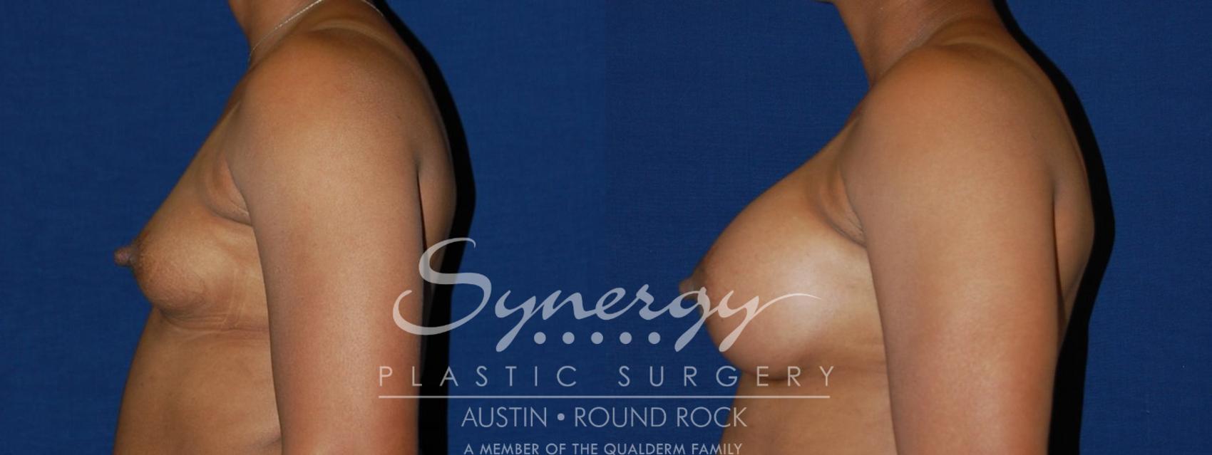 Before & After Breast Augmentation Case 85 View #1 View in Austin, TX