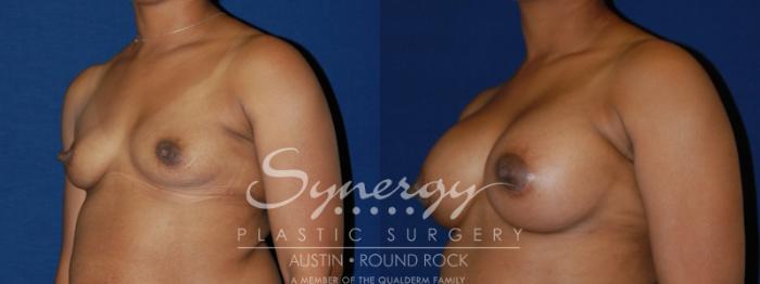 Before & After Breast Augmentation Case 85 View #2 View in Austin, TX