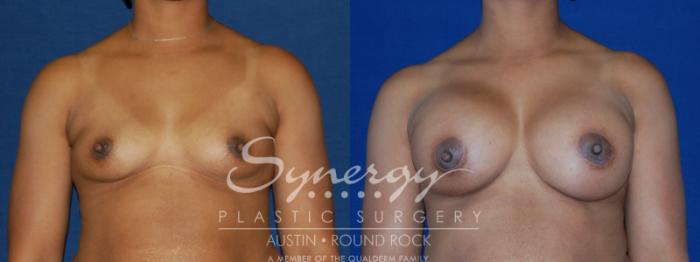 Before & After Breast Augmentation Case 85 View #3 View in Austin, TX