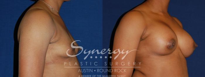 Before & After Breast Augmentation Case 85 View #4 View in Austin, TX