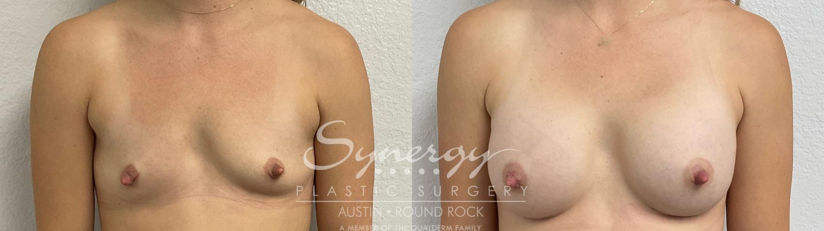 Before & After Breast Augmentation Case 858 Front View in Austin, TX