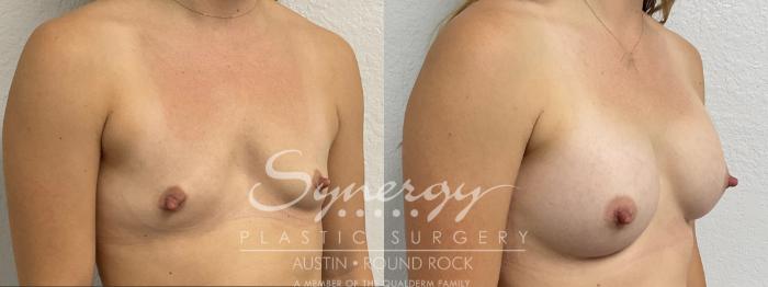 Before & After Breast Augmentation Case 858 Left Oblique View in Austin, TX