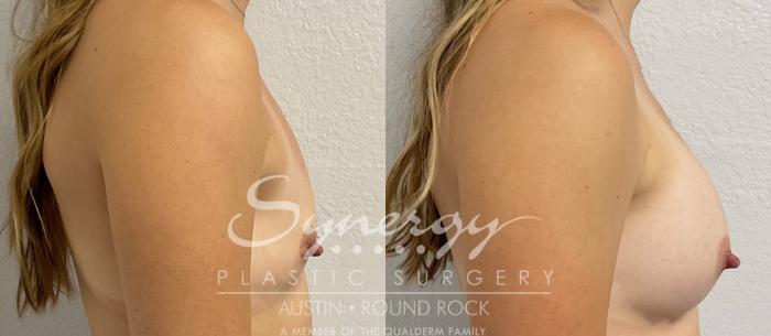 Before & After Breast Augmentation Case 858 Left Side View in Austin, TX